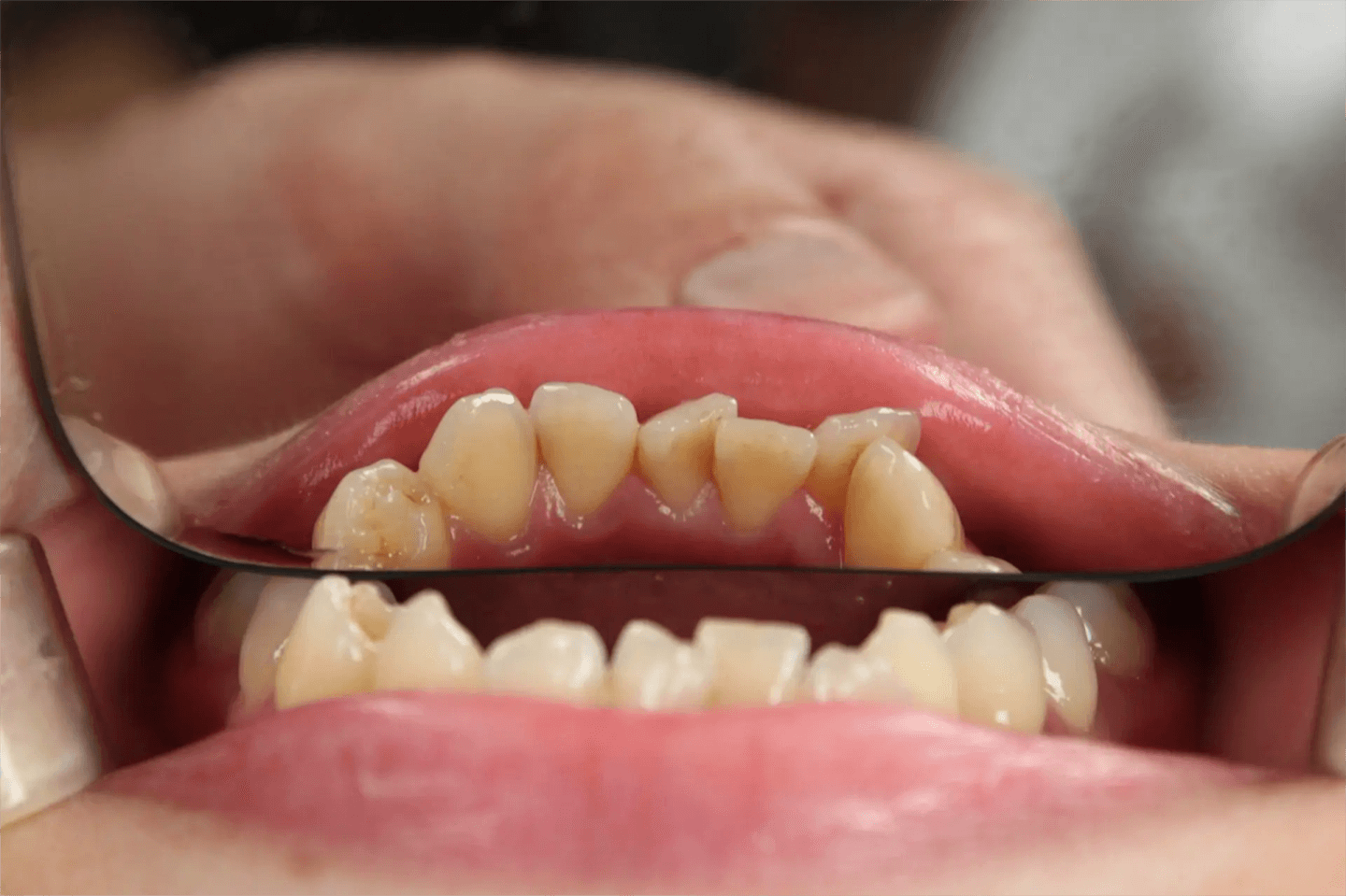 Primer plano de una boca abierta que muestra dientes y encías amarillentos, vistos a través de un espejo dental sostenido por una persona.