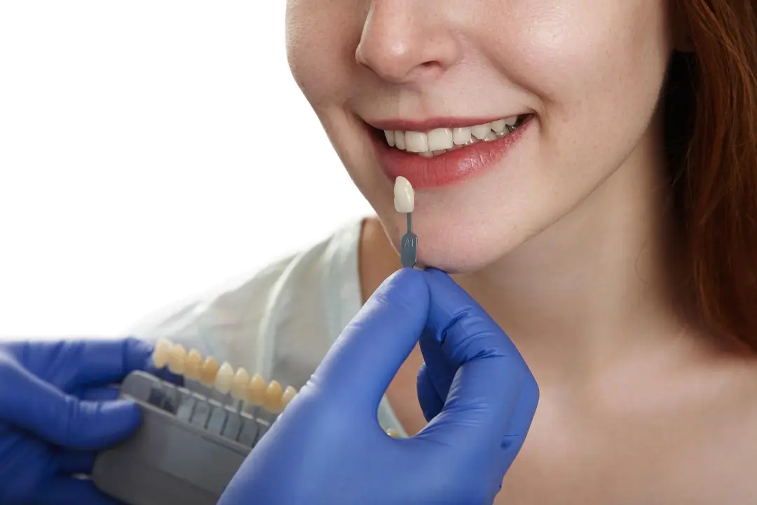 Un profesional dental con guantes azules sombrea una guía de colores de dientes junto a la boca de un paciente para una evaluación cosmética.