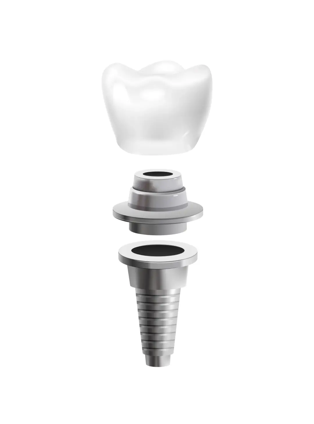 Tres componentes de un implante dental: una corona dental blanca en la parte superior, un pilar de metal en el medio y un tornillo de implante roscado en la parte inferior.
