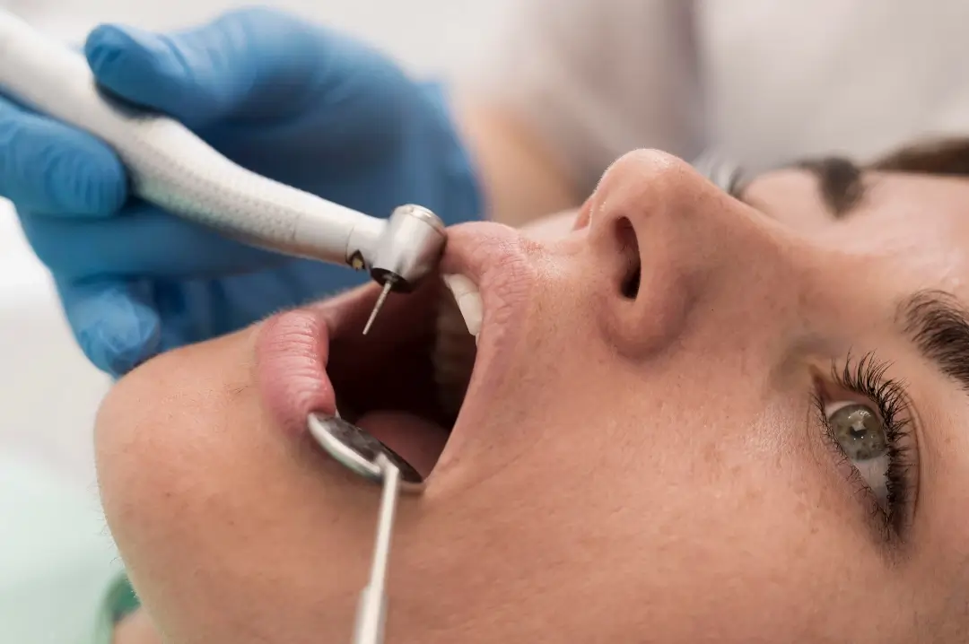 Un profesional dental con guantes azules utiliza una herramienta dental cerca de la boca de un paciente durante un tratamiento dental.